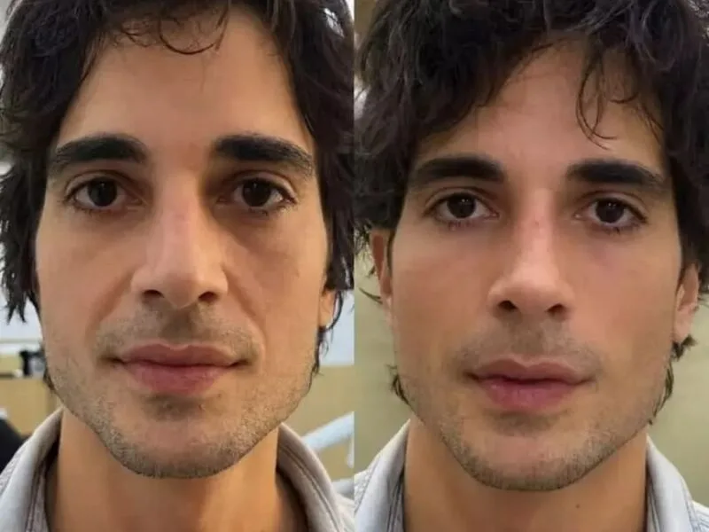 Fiuk apresenta resultado de harmonização facial no Fofocalizando