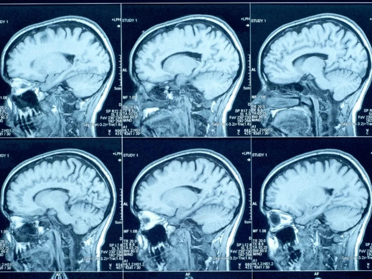 Queda em idosos pode causar hematoma cerebral com sintomas tardios